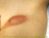Local lymph swelling near scratch site